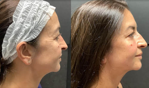 rf laser skin tightening before after mississauga oakville